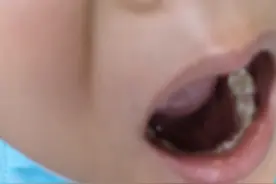 舌下腺囊肿！只能手术吗？孩子那么小实在不忍心啊😭视频封面