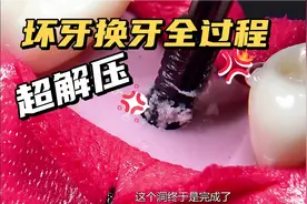 高清第一视角拔齿，撬牙齿那一刻，真的太刺激了！视频封面