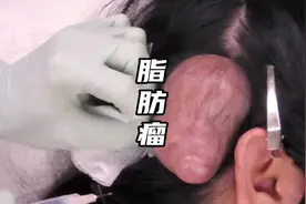 头上长了一个拳头大小的肿块原来是这…
