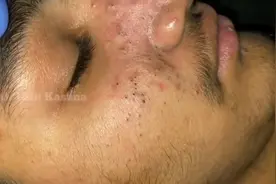 解压 沉浸式挤黑头视频封面