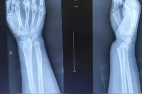 手指麻木也许不是颈椎病图片