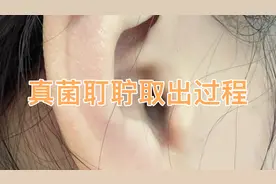 真菌性外耳道炎耵聍取出过程