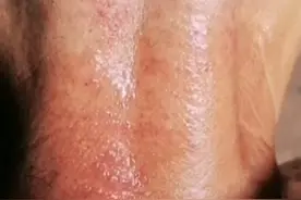 看我婊姑颈癣几年了，用油抹抹就好了，视频封面