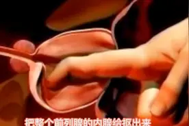 高清动画展示直肠指检和前列腺开放手术过程，很酸爽！