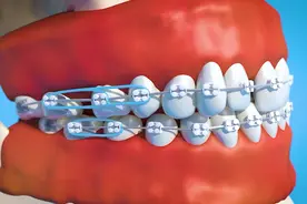 3D动画立体展示牙齿矫正全过程