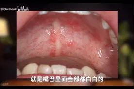 槟榔是一个慢性毒品 朋友们要控制戒掉