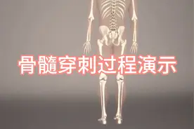确诊白血病需要做骨髓穿刺，看着都疼！视频封面