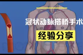 冠状动脉搭桥手术演示过程，看完你会惊叹心外科医生的胆大心细！视频封面