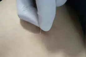 俞润小竹脊椎特色疗法，中医有道书院挑针疗法有效根除痔疮。视频封面