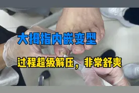 老师傅修脚趾甲内嵌变型，过程十分舒爽，非常解压，强迫症的福音