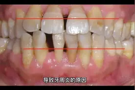 牙周炎是怎么形成的？视频封面
