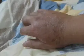 断了一根手指头，中草药包了21天，恢复差不多了视频封面