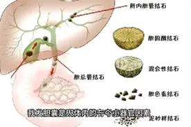 胆囊摘除后影响寿命吗？