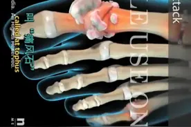 （3D医学动画）痛风石的前因后果视频封面