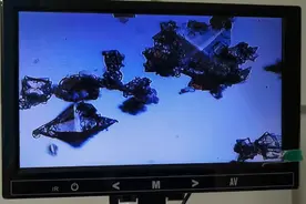江西前列腺炎病友，钙化严重，第一次理疗就排出大量草酸钙结晶。视频封面