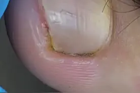 指甲被砸了，整个指甲都给拿了，疼痛自知啊