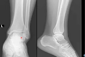 影像基础知识：踝关节骨解剖讲解，简单易懂，3分钟学会