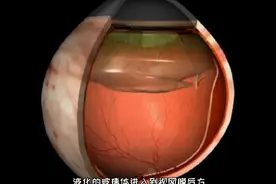 视网膜脱落发生原因，不手术为什么会失明，3D演示。。