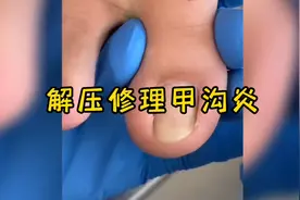 指甲扎到肉里怎么办，当然是把它揪出来啦，过程十分解压视频封面