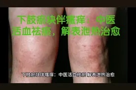 下肢瘀块伴瘙痒：中医活血祛瘀，解表泄热治愈视频封面