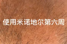 使用米诺地尔治疗脱发、生发第六周，感觉细小毛发长出来了🤔🤔🤔视频封面