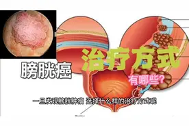 膀胱癌的治疗方式有哪些？膀胱癌术后复查尤为重要！视频封面