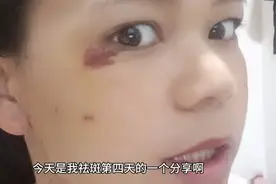 祛斑第四天，结痂更让我受不了，眼睛一闭上就刺痛视频封面