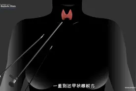 甲状腺全切除手术过程，3D演示。。视频封面
