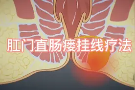 肛门直肠瘘挂线疗法演示，已收藏！视频封面