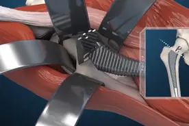 【3D动画演示全髋关节置换术】视频封面