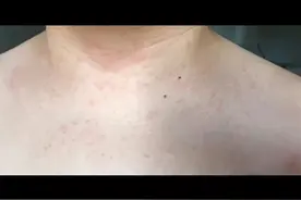 孕期起疙瘩该怎么办视频封面