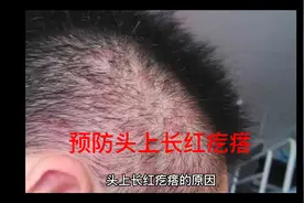 头上长红疙瘩，如何预防控制视频封面