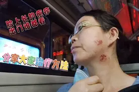 脸上长的疱疹太受人们关注了，治疗方法非常简单，分享给大家视频封面