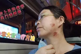 脸上长的疱疹太受人们关注了，治疗方法非常简单，分享给大家视频封面