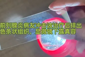 福建前列腺炎病友冲击波治疗后排出白色条状组织，显微镜下露真容视频封面