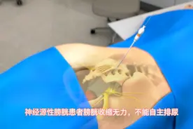人工植入骶神经刺激器，帮助解决神经源性膀胱患者排尿问题！视频封面