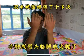双手被蜜蜂蛰了十几下肿成馒头状，胳膊都肿成火腿了，幸好没蛰脸视频封面