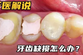 牙齿缺损后，没钱种植牙怎么办？全瓷冠 烤瓷冠 黄金冠 一切皆可视频封面