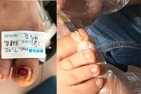 指甲受外伤以后，千万不要去拔甲，拔坏指甲去掉，不久就长好指甲