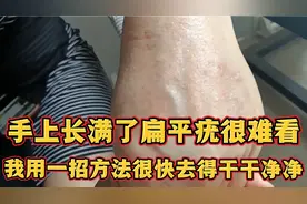 手上长满了扁平疣很难看，我用一招方法祛除的干干净净