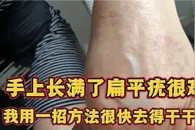 手上长满了扁平疣很难看，我用一招方法祛除的干干净净