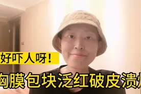 太吓人了！转移包块泛红破皮溃烂，吃劳拉替尼还会这样视频封面