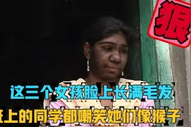 这三个女孩脸上都长满了毛发，到底是什么原因导致的呢？视频封面
