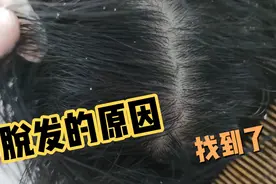 用茶麸茶油洗头熏蒸，排出堵塞在毛囊里的顽固油脂，疏通毛囊视频封面