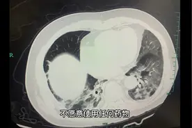 70岁中医肺炎却拒绝治疗，看着他病情加重，却无能为力视频封面