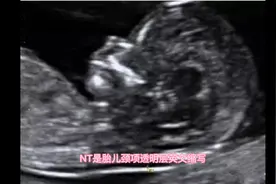 一分钟带你了解胎儿NT，不只是测量数值这么简单视频封面