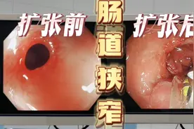 效果立竿见影！肠道狭窄，大便拉不出来，用水囊扩张！马上通畅！视频封面