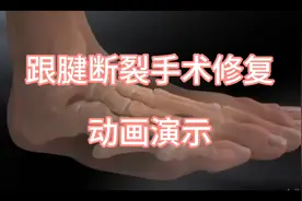 跟腱断裂手术修复动画演示，大家觉得能长好吗？视频封面