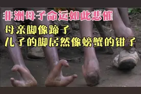 非洲母子命运如此悲催  母亲的脚像蹄子  儿子脚居然像螃蟹的钳子视频封面