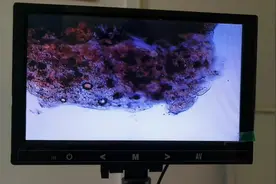 贵州前列腺炎病友，前列腺小管堵塞严重，疏通后脓细胞团排出来视频封面